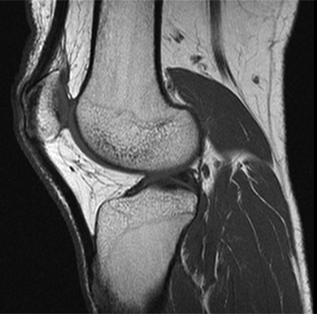 МРТ мышц коленного сустава