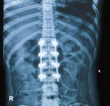 Рентген перелома грудного отдела позвоночника