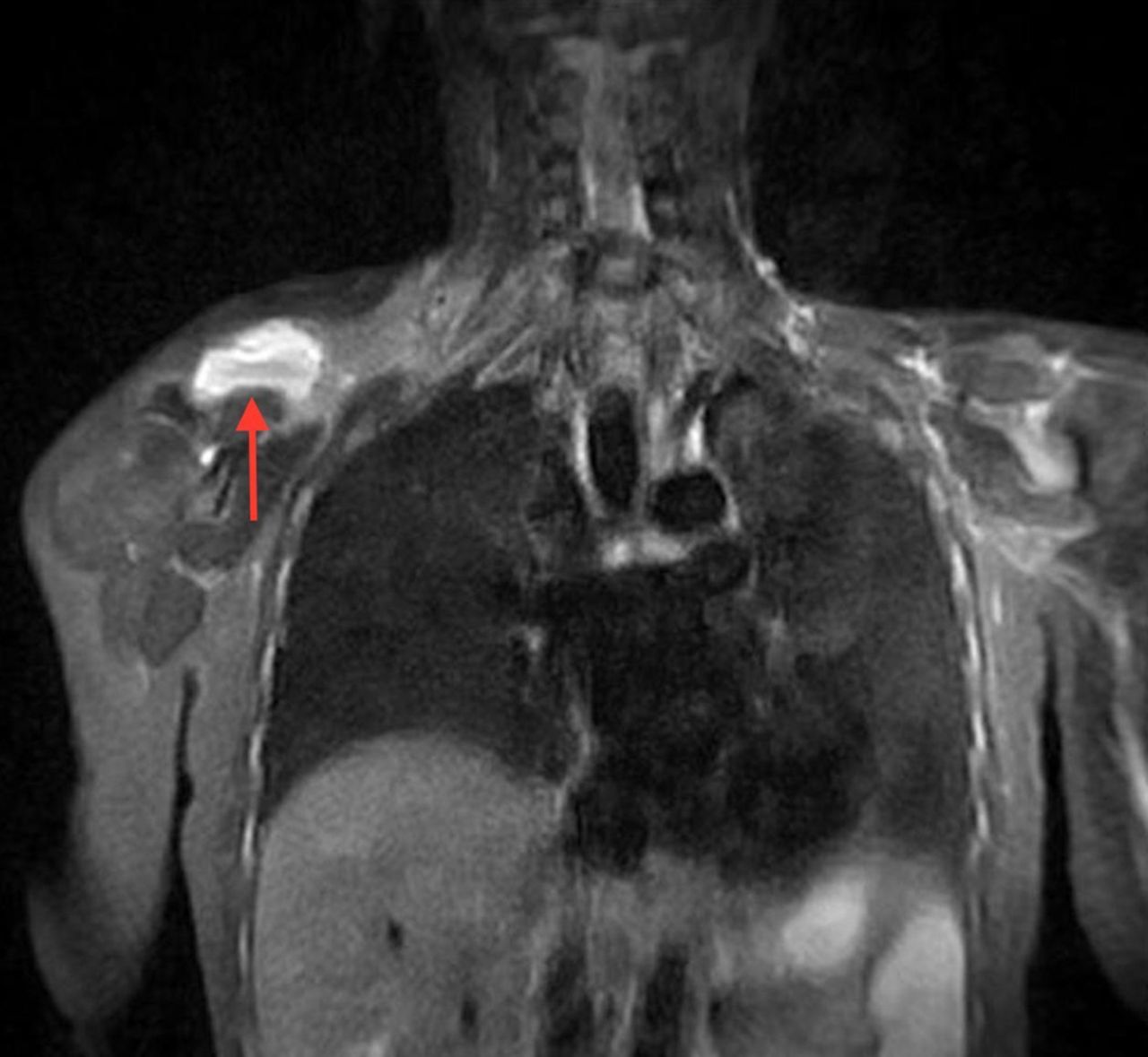 МРТ трапециевидной мышцы спины