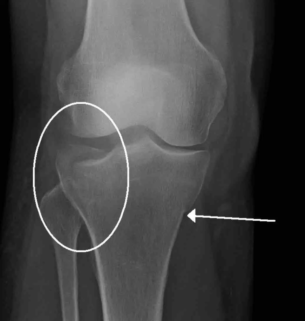 Рентген перелом колена