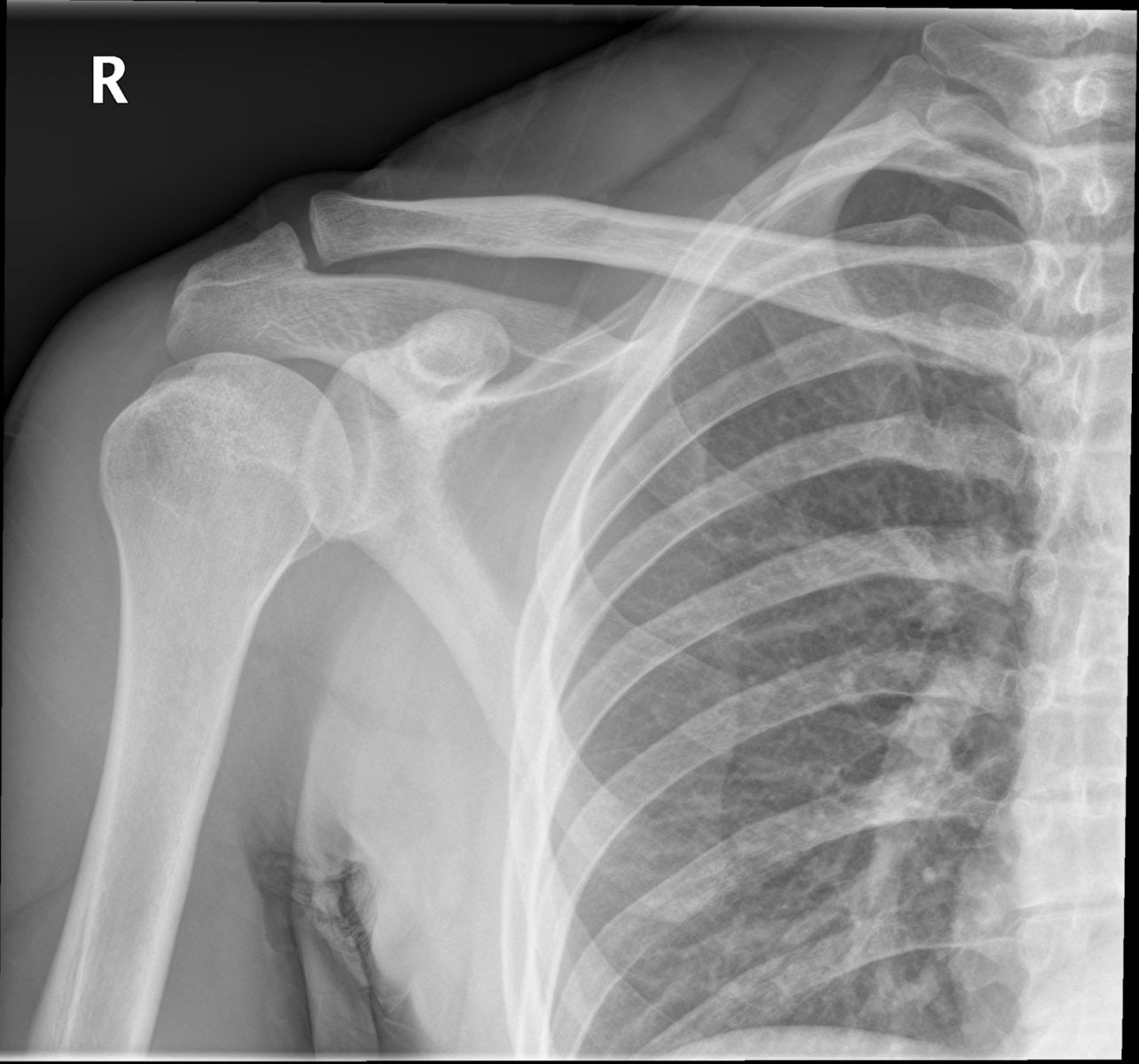 Рентген перелома плеча