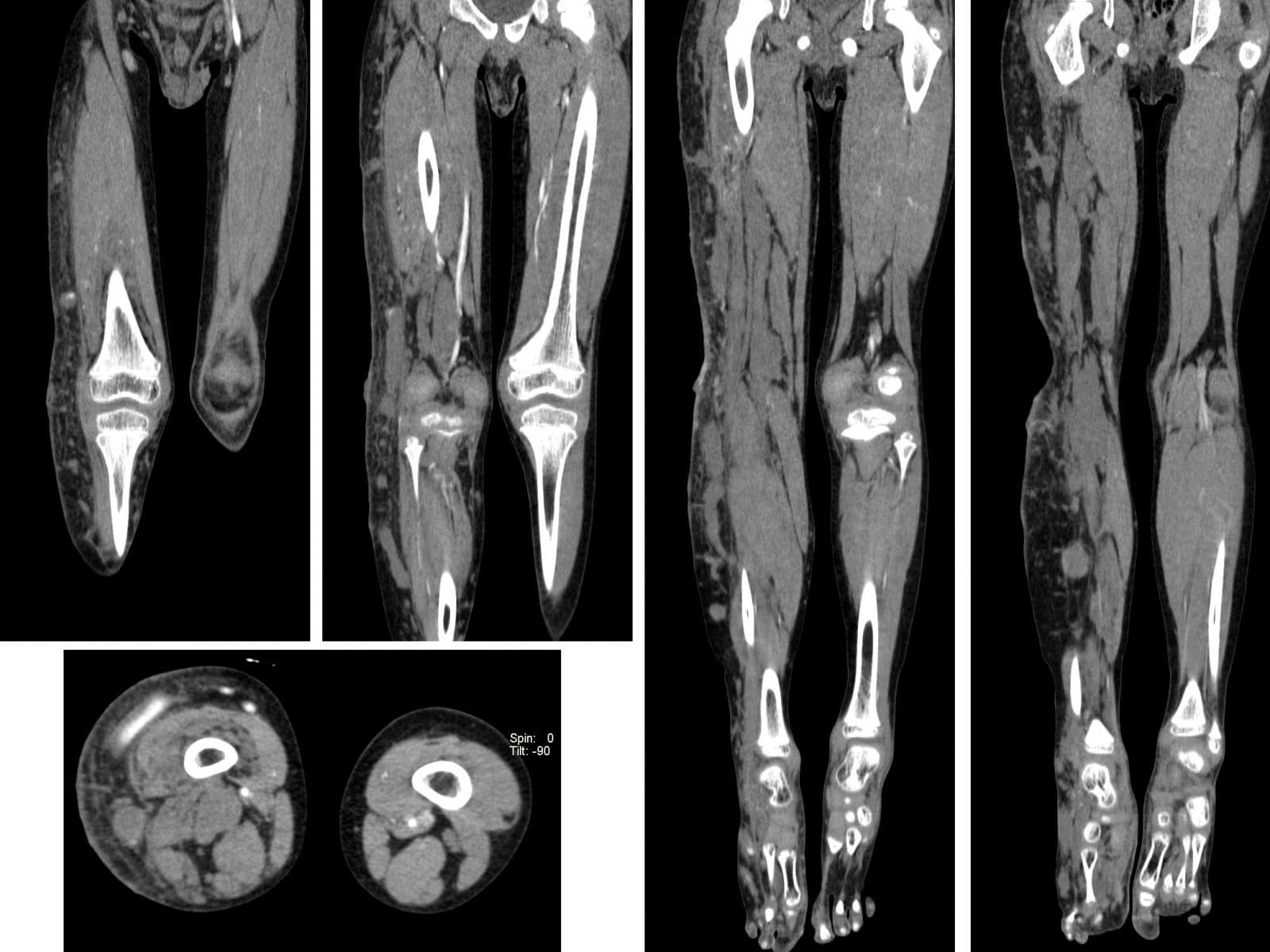Вены нижних конечностей кт. СКТ вен нижних конечностей. Мрт большеберцовой кости. Кт-ангиография артерий нижних конечностей.