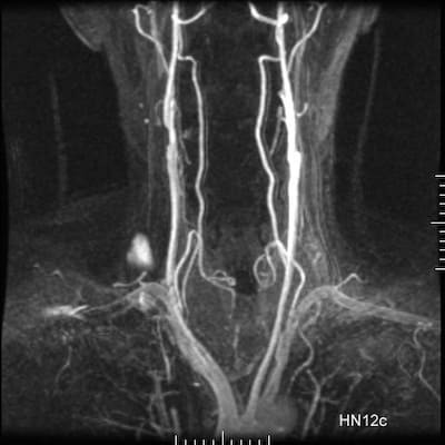 Мрт артерий шейного отдела