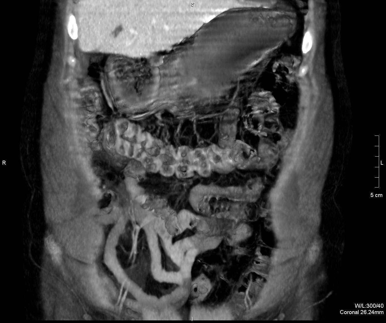 КТ желудка и кишечника снимок