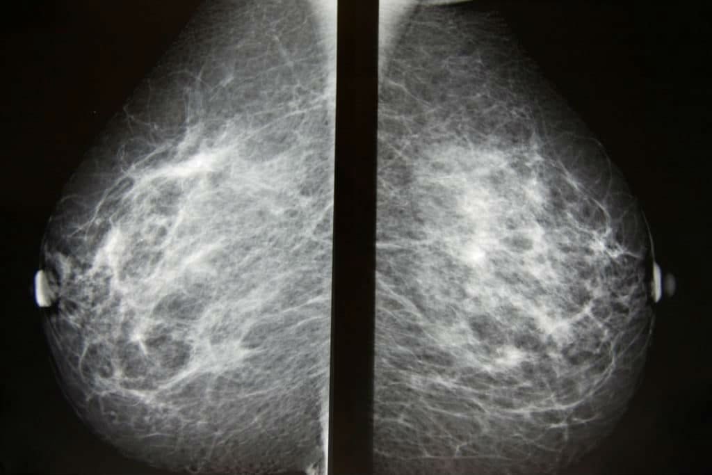 КТ маммография снимок