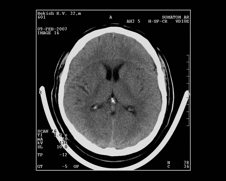 КТ головного мозга с контрастиом снимок