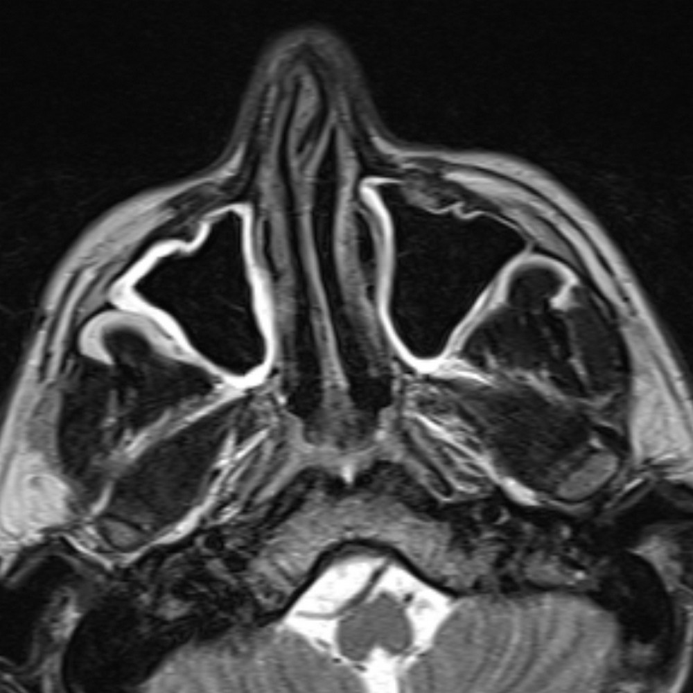 МРТ придаточных пазух носа снимок
