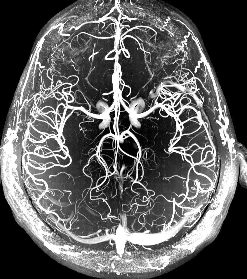 МРТ сосудов головного мозга с контрастом снимок